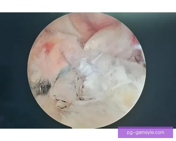 越南U23中卫前十韧带撕裂将手术